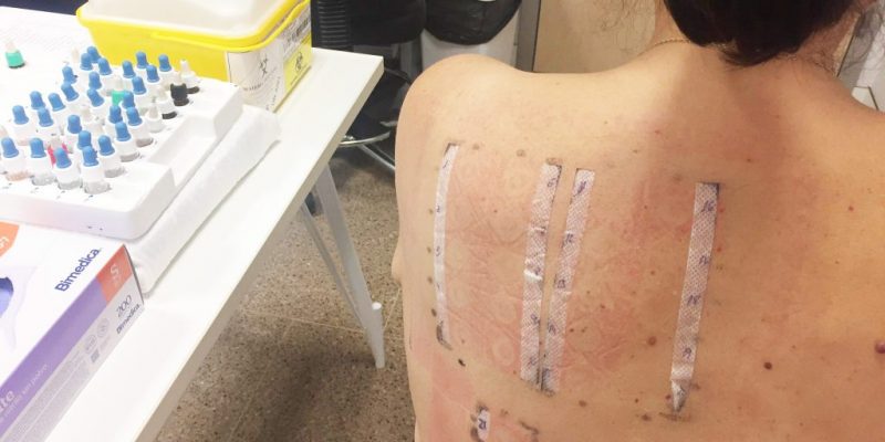 Los hospitales Vinalopó y Marina Baixa demuestran la baja prevalencia en alergia a parabenos